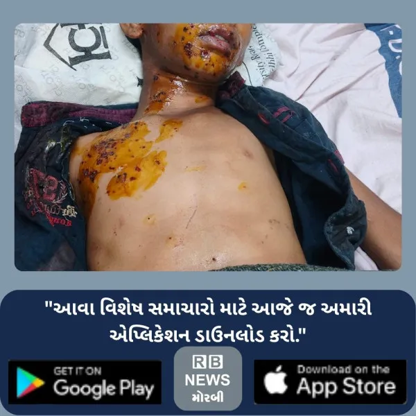 કચરામાંથી મળેલી રમકડાની જૂની બેટરી અચાનક ફાટતા બાળક દાઝી ગયો